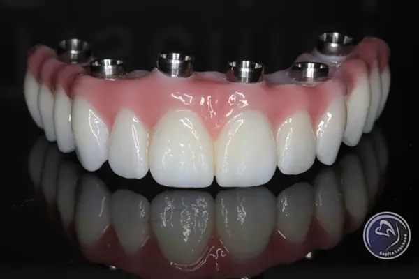 از چه موادی در ساخت پروتزهای دندانی استفاده می شود؟