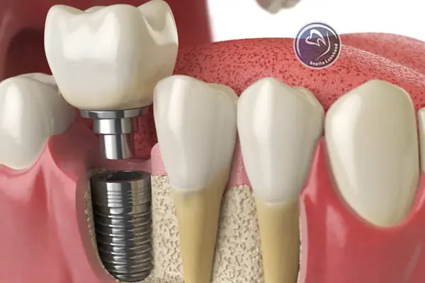 پروتز دندان ثابت بر پایه ایمپلنت