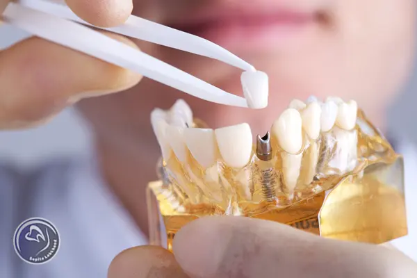 قیمت پروتز دندان ثابت چقدر است؟