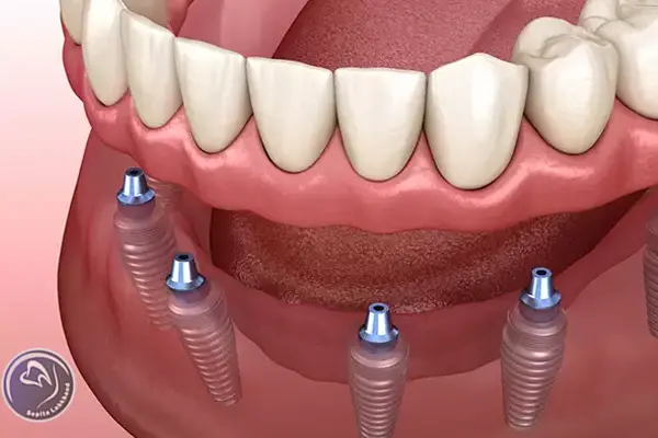 مزایا و معایب پروتز دندان ثابت