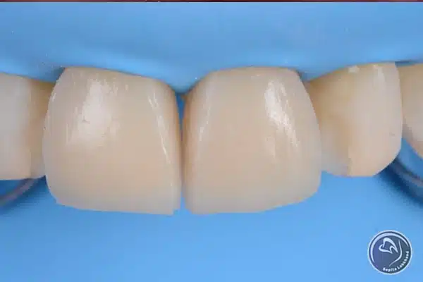 کاربرد ونیر دندان چیست؟