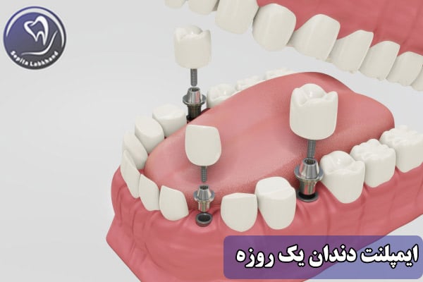 ایمپلنت دندان یک روزه
