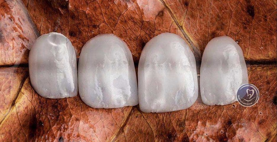 بهترین نوع لمینیت دندان کدام است