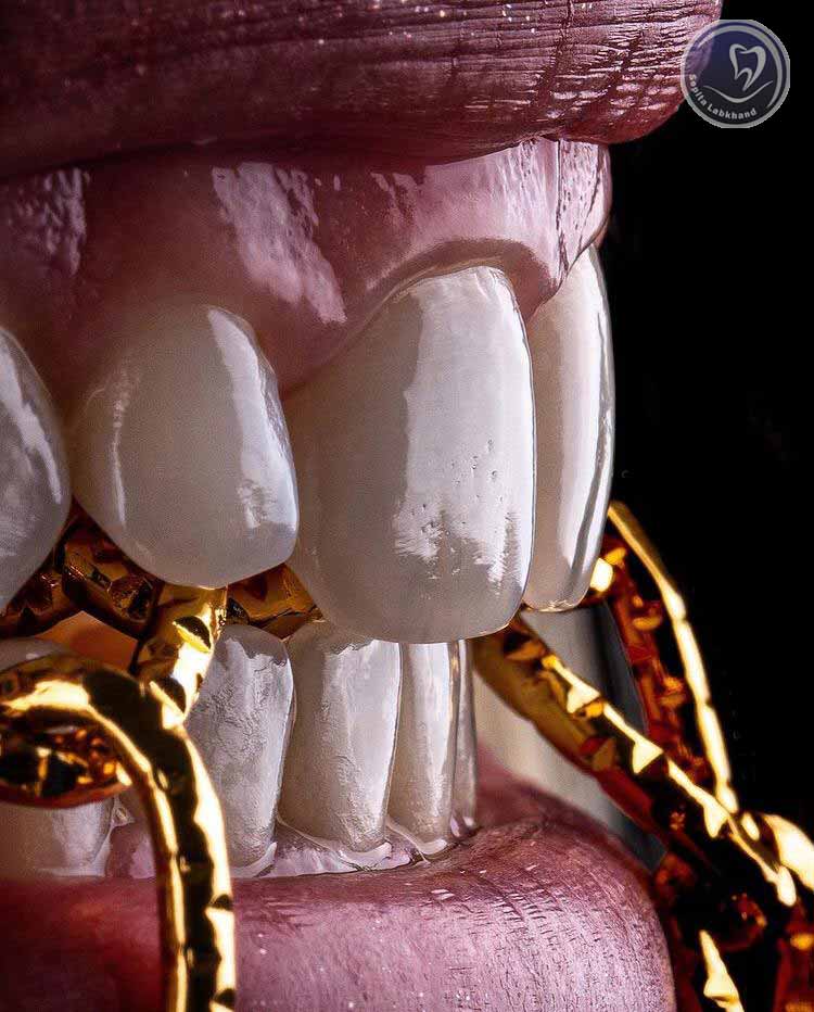 نوع لمینت سرامیکی دندان