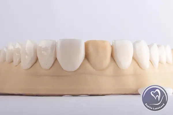 روکش دندان زیرکونیا چه نوع روکشی است؟