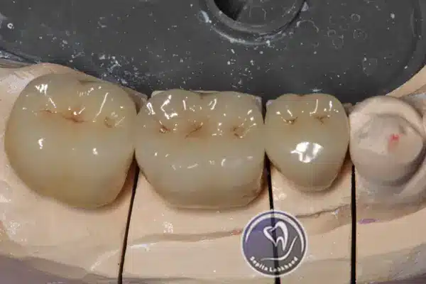روکش دندان چیست