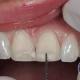 پوسیدگی دندان ها دلیل تراش دندان برای زیرکونیا