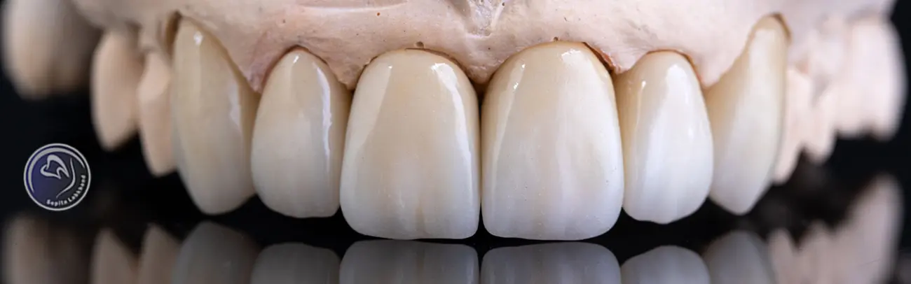 آنچه باید درباره عمر روکش دندان زیرکونیا بدانید!