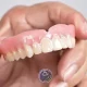 فول دنچر یا دست دندان کامل چیست؟