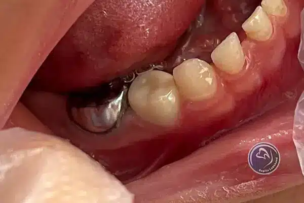 مزایای روکش کردن دندان عصب کشی شده