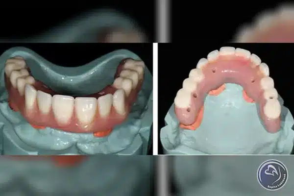 عوامل موثر بر ماندگاری پروتز دندان ثابت