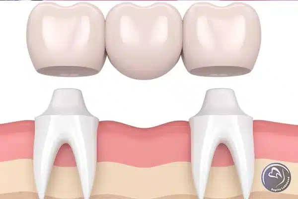 انواع پل های دندانی را بشناسید!