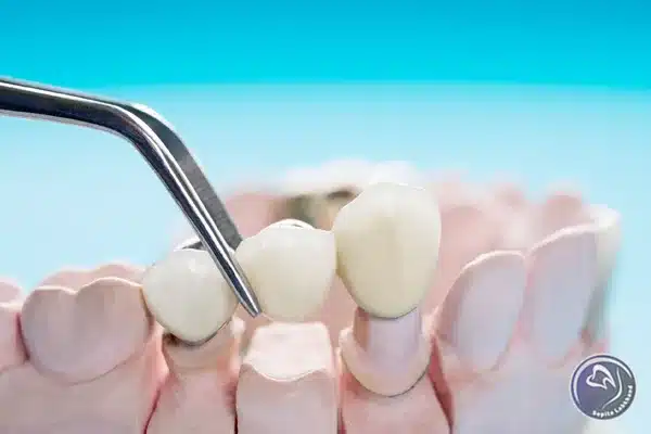 مزایا بریج دندان چیست؟