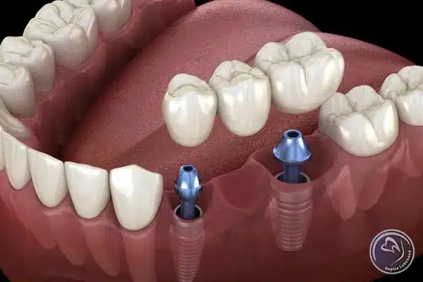 نصب بریج دندان بر پایه ایمپلنت