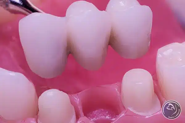 پل دندان و کاربرد آن چیست؟