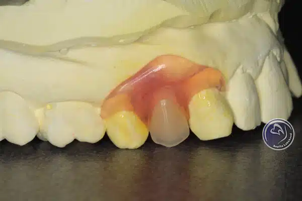 مراحل ساخت Removable single tooth prosthesis
