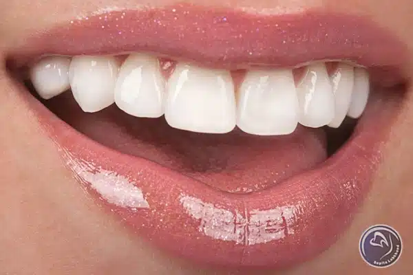 کاربردهای ونیر دندان چیست؟