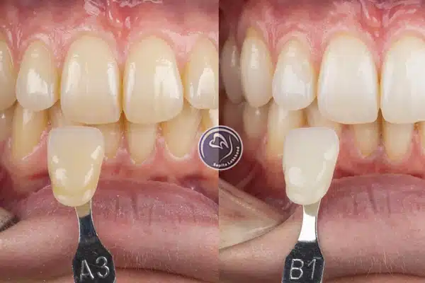 تفاوت رنگ های کامپوزیت دندان