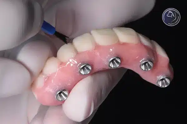 مراحل انجام پروتز دندان ثابت