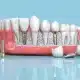 مراحل و نحوه انجام پروتز دندان (پروتز ثابت و متحرک)