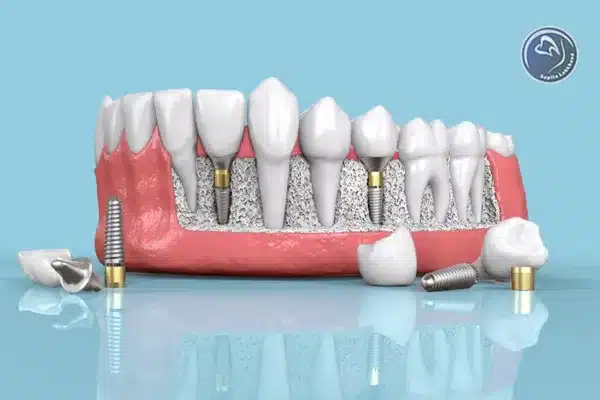 مراحل و نحوه انجام پروتز دندان (پروتز ثابت و متحرک)