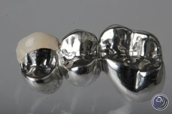 جنس و متریال روکش های فلزی دندان