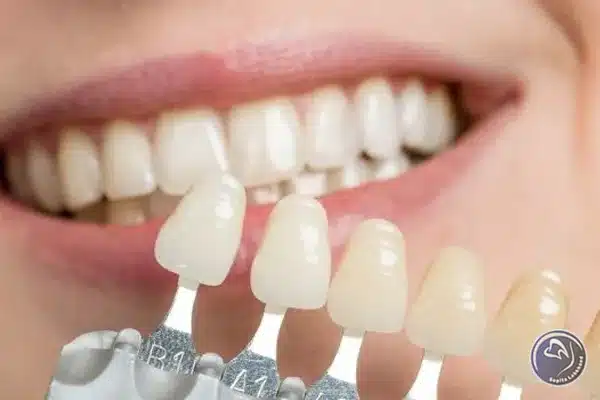 روکش دندان سرامیکی بهتر است یا فلزی؟